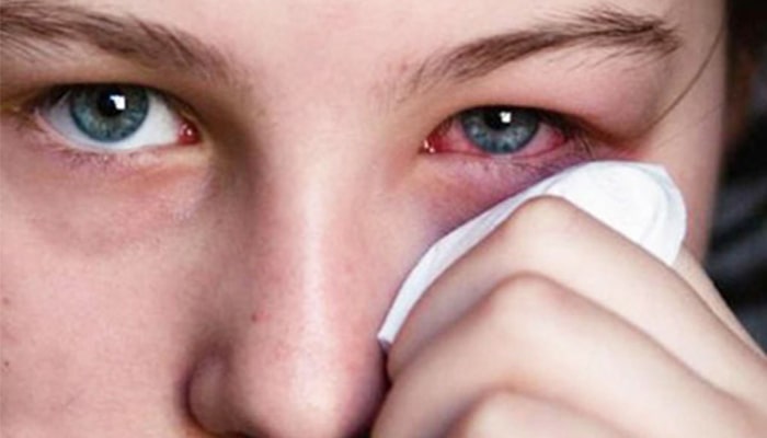 عوارض هیپوکلریت سدیم