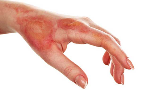 خطرات آمونیاک مایع